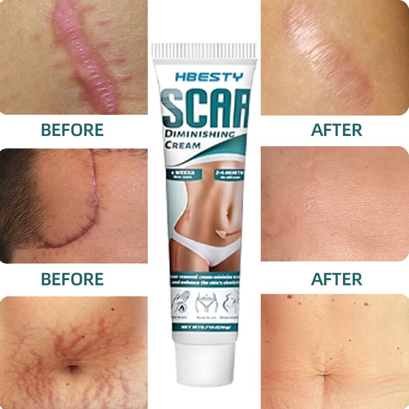 5 piece Scar Removal Cream